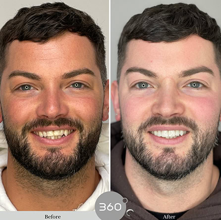 Before and after : 