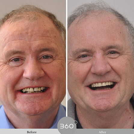 Before and after : 