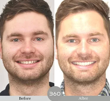 Before and after : 