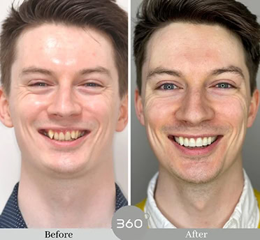 Before and after : 