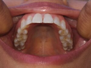 Example upper arch photo