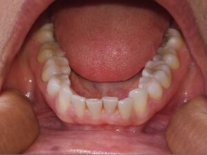 Example lower arch photo