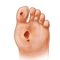 STEM CELLS – THE REALISTIC APPROACH ON WOUND HEALING