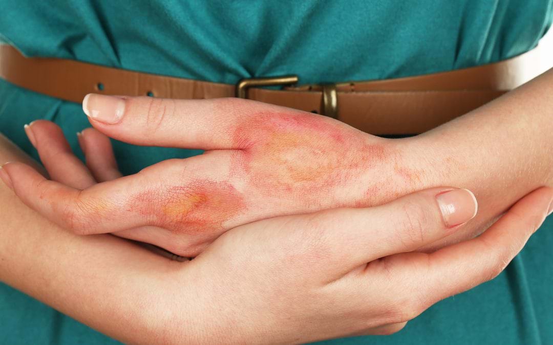 Stem Cells Treatment for Skin Burns: A Futuristic Approach!