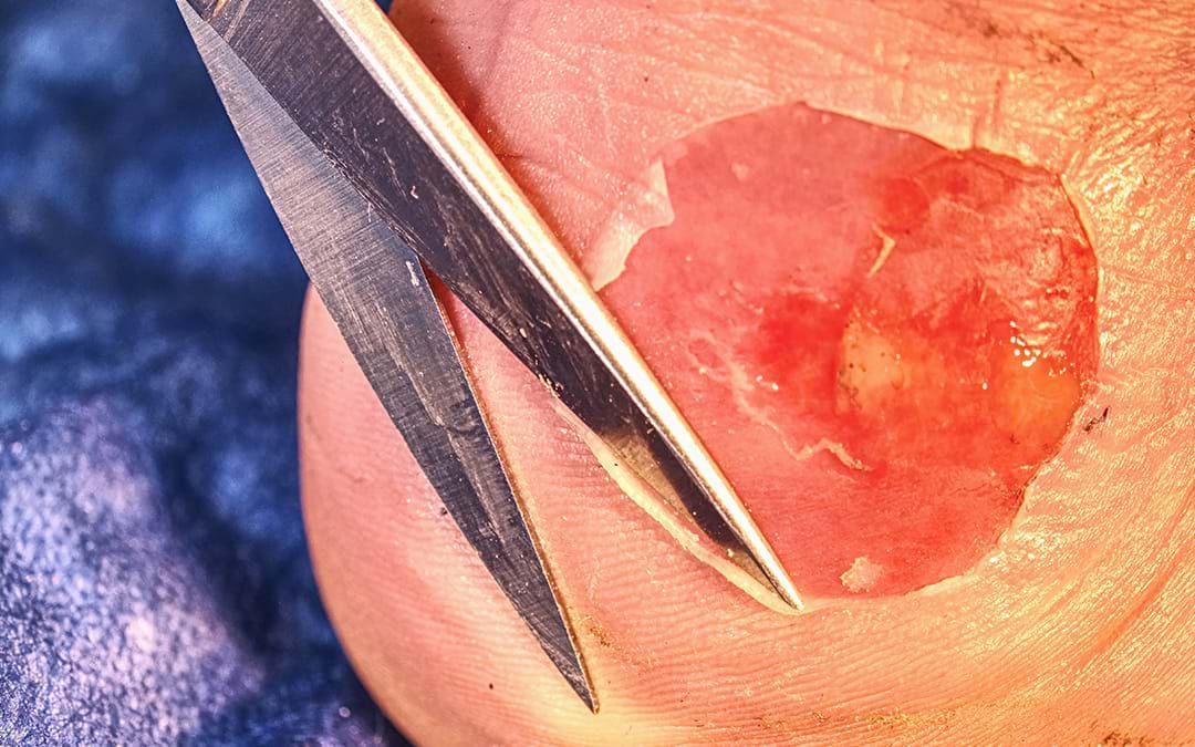 How Does PRP Therapy Help In Wound Healing?