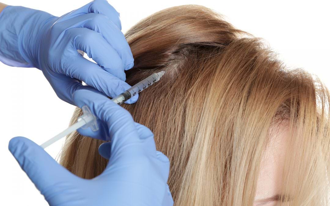 How Effective is Stem Cell Injection for Hair Loss?