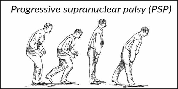Progressive Supranuclear Palsy (PSP)