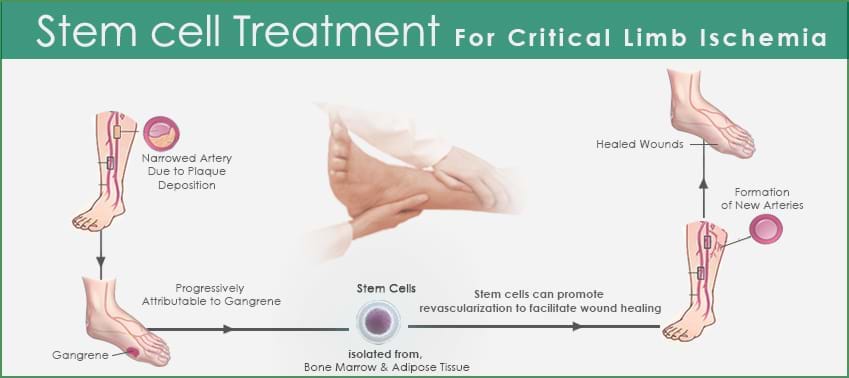 The Critical Limb Ischemia: The silent killer