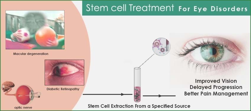 Stem Cell Therapy For Macular Degeneration