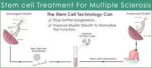 Multiple Sclerosis Stem Cell Process