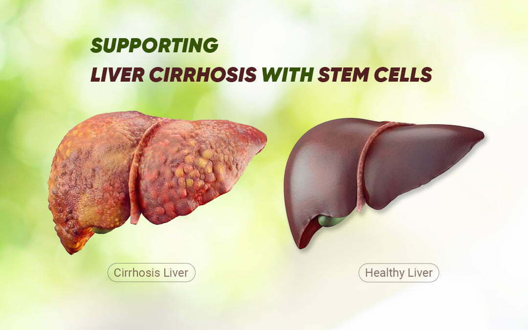 Stem Cell Therapy For Liver Disease