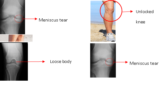 Locking And Unlocking The Locked Knee