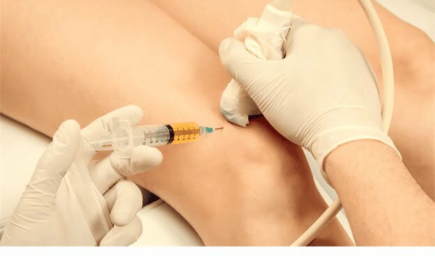 Platelet Rich Plasma (PRP) for Osteoarthritis