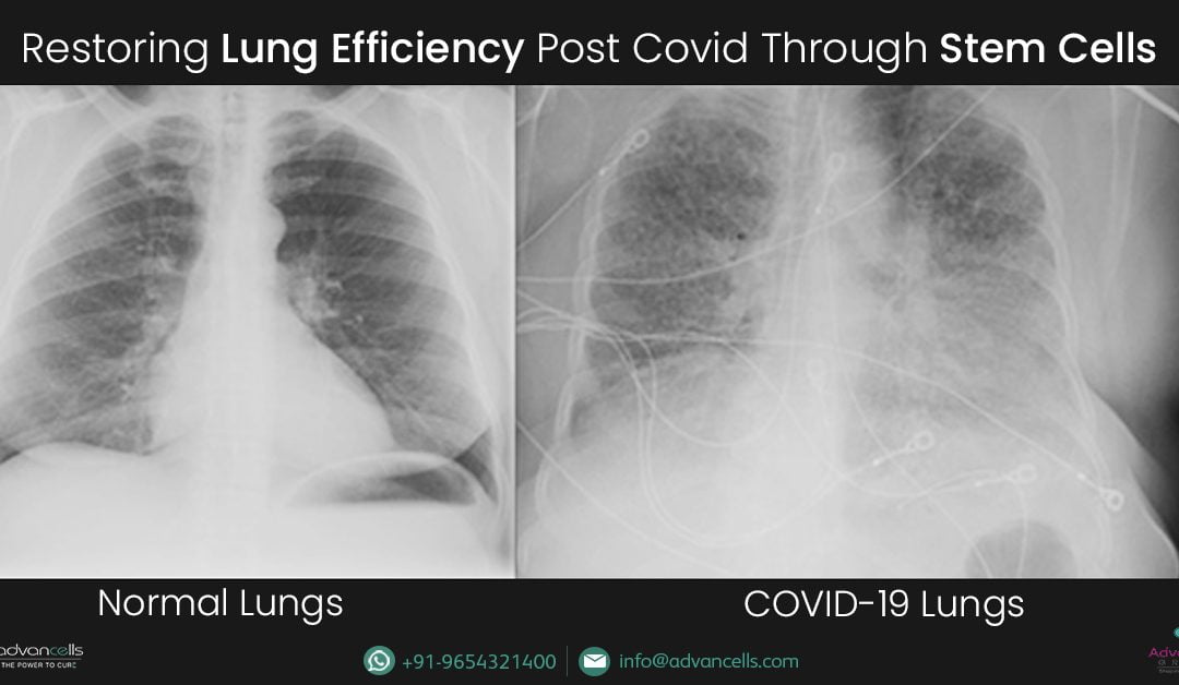 Can Stem Cells be Used to Regrow Lung Tissue in Post Covid?