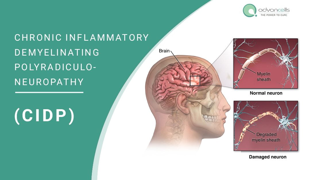 CIDP Disease: Causes, Diagnosis, Symptoms, and Treatment