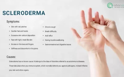 Scleroderma Symptoms, Causes, Types, and Available Treatments