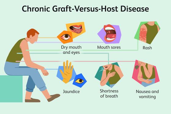 Is Stem Cell Transplant Safe For GVHD?
