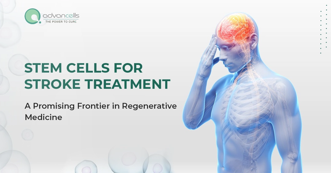 Stem Cells for Stroke Treatment: A Promising Frontier in Regenerative Medicine