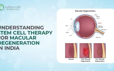 Exploring Stem Cell Therapy for Macular Degeneration in India: Hope for Vision Restoration?