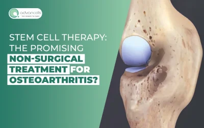 Stem Cell Therapy: The Promising Non-Surgical Treatment for Osteoarthritis?