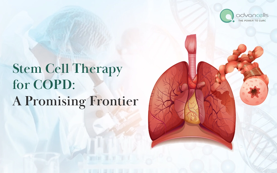 Stem Cell Therapy for COPD: A Promising Frontier