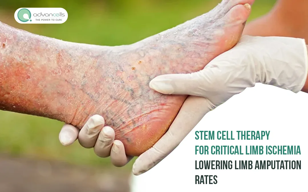 Stem Cell Therapy for Critical Limb Ischemia Lowering Limb Amputation Rates