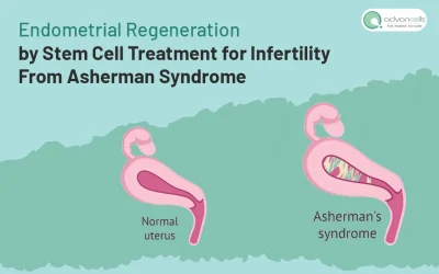 Endometrial Regeneration by Stem Cell Treatment for Infertility from Asherman Syndrome