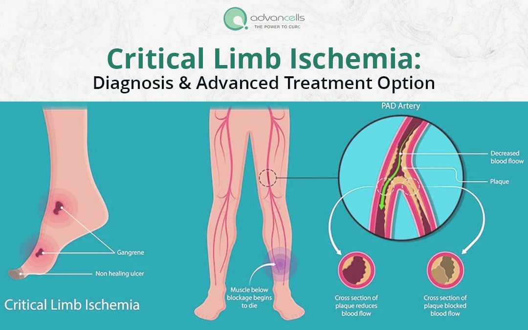 Critical Limb Ischemia: Diagnosis and Advanced Treatment Option