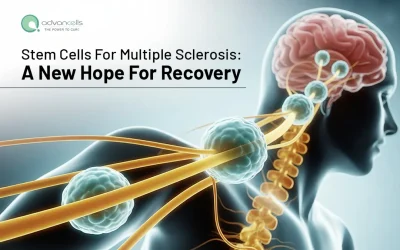 Stem Cells For Multiple Sclerosis: A New Hope For Recovery