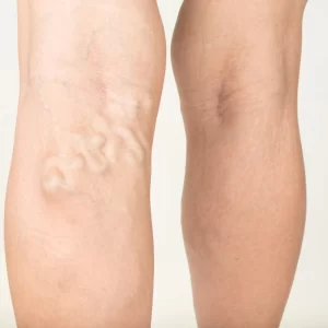 Piccoli interventi di rimozione di ulcere cute e vene superficiali