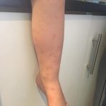 Bed bug bites