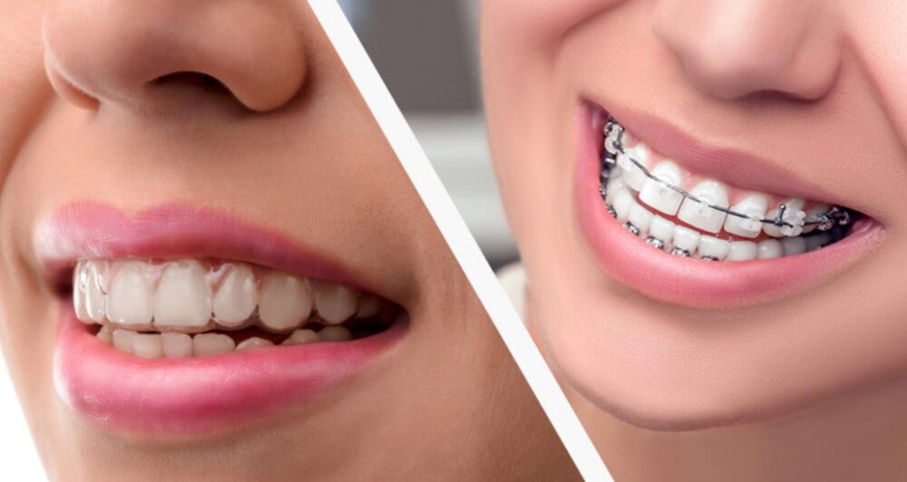 Braces Vs Invisalign