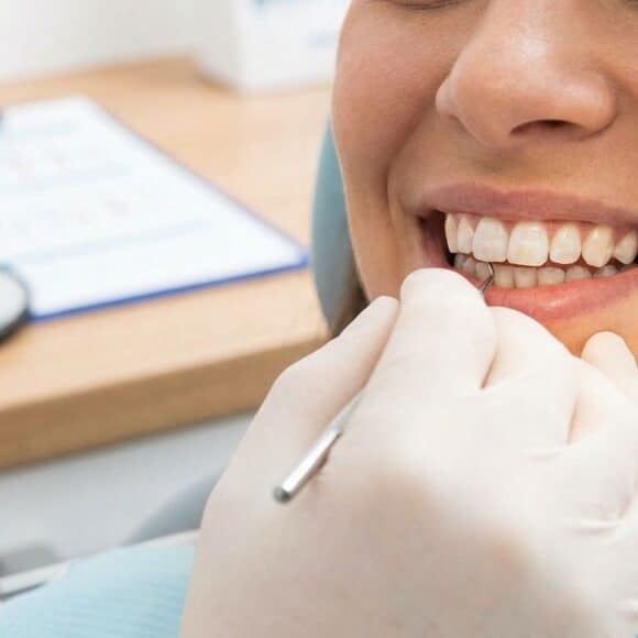 White Spots on Teeth Fluorosis Treatment (2026 Guide)