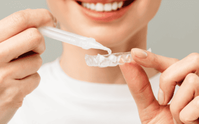 Teeth Whitening Brisbane: Professional Kits vs Store-Bought Products