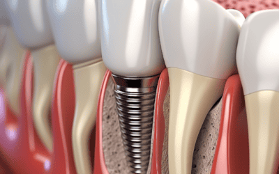 Cost of Dental Implants Brisbane CBD: What to Expect