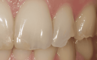 Cracked tooth? What now?