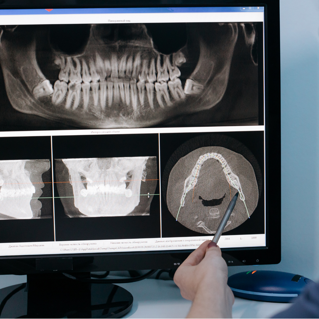 Dental implant planning with a CBCT