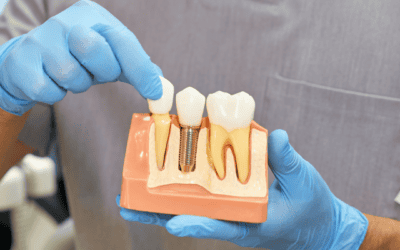 Dental Implants in Brisbane CBD – Restore Your Smile with Confidence