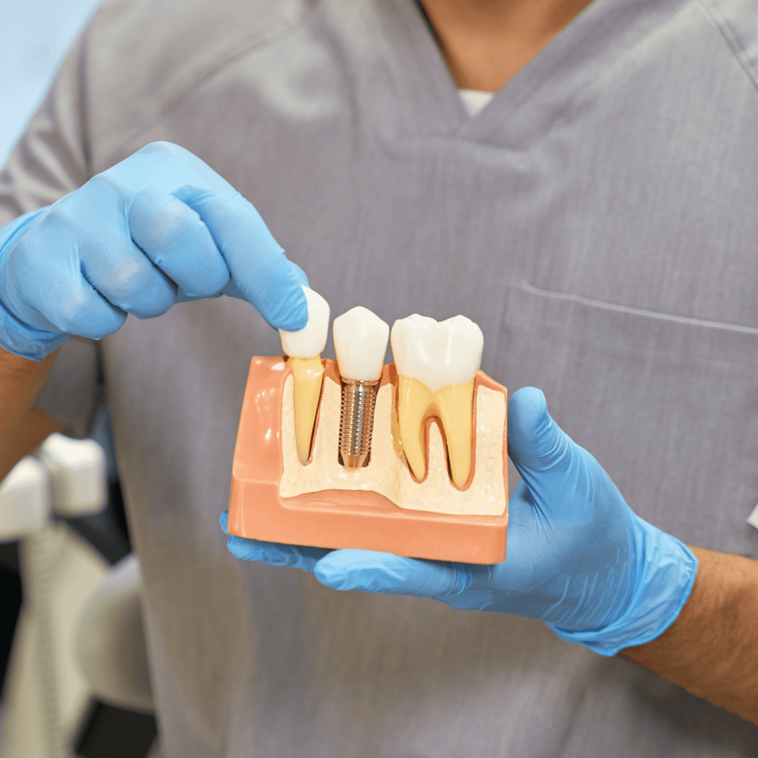 Dental Implants Brisbane