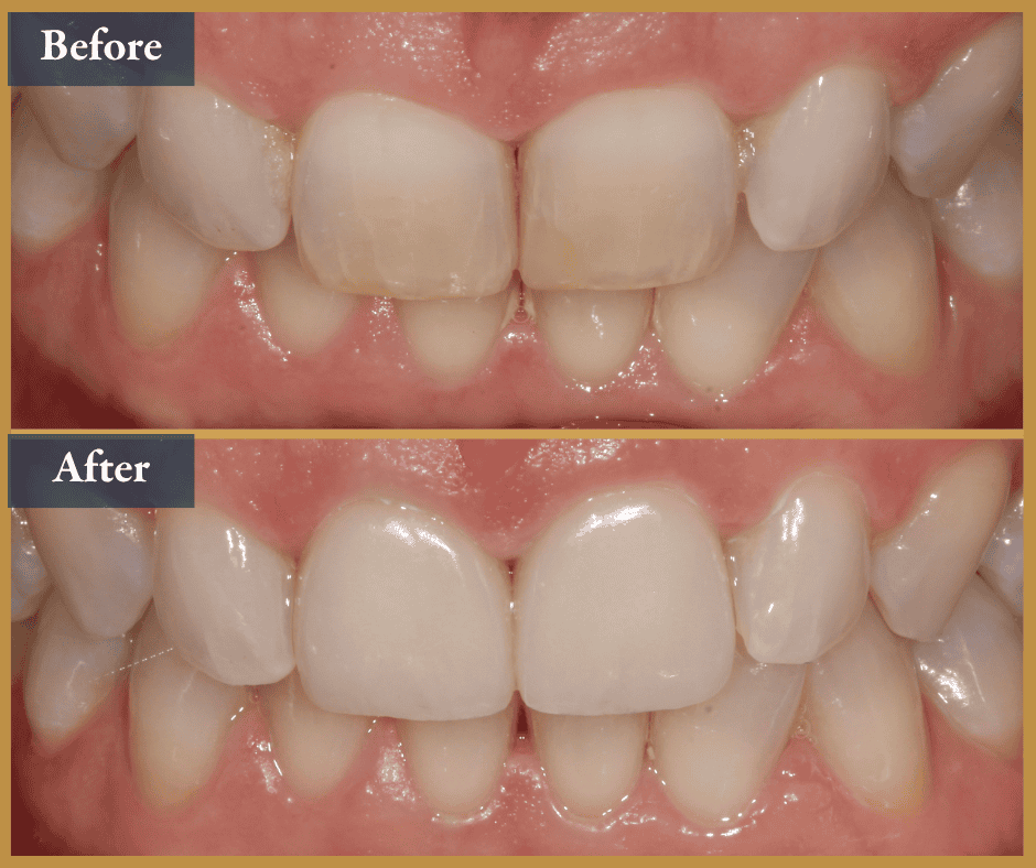 porcelain veneers brisbane