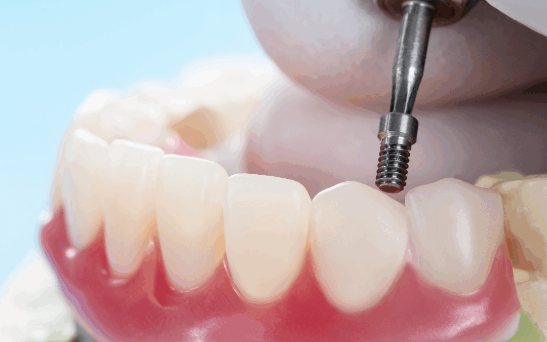 Dental Implants vs. Dentures: Which is Right for You