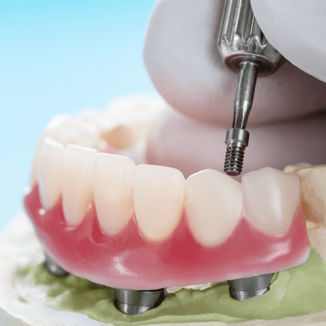 dental implant supported denture being screwed into place