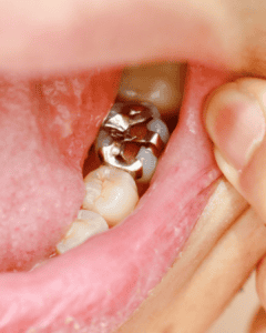 dental crowns brisbane cbd