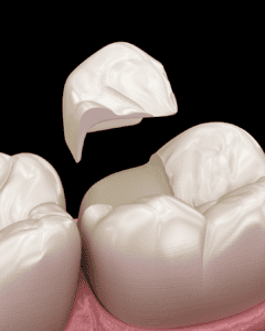 dental onlay brisbane cbd