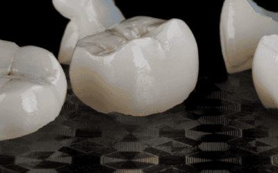 Crown vs Onlay: How We Decide What’s Right for Your Tooth