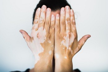 Treating Vitiligo