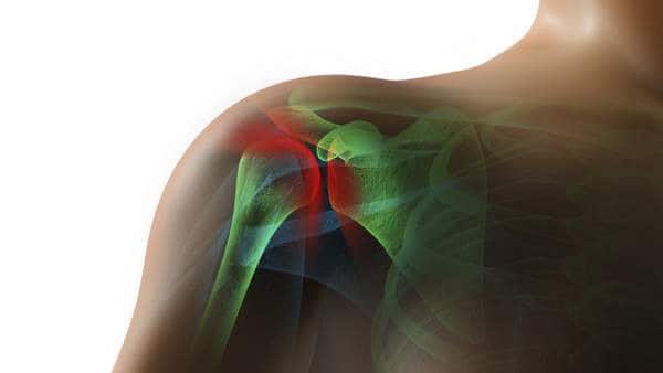Inside of Shoulder (Rotator cuff injury, subacromial bursitis, glenoid labral tears) inflamation