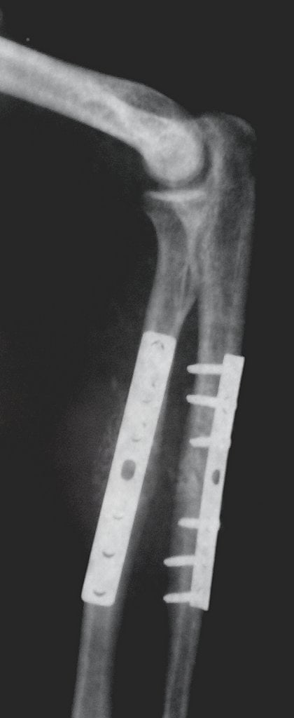 Internal fixation of the radius & ulna