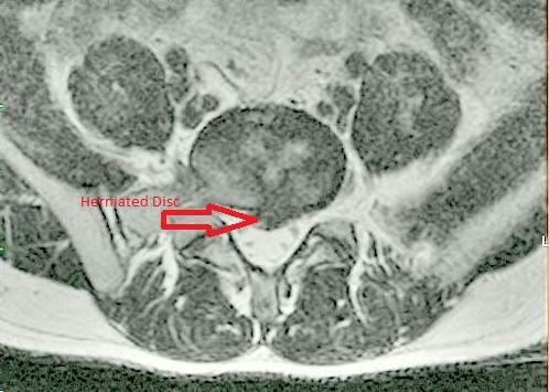 Broad Based Central Herniated Disc in Lower Back