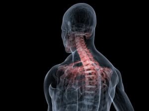 Herniated Disc Settlement Accident Neck Back Injuries Car Crash